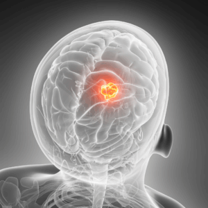 Illustration of a brain with a tumor