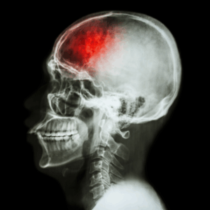 X-ray of human skull with stroke region colored in red.